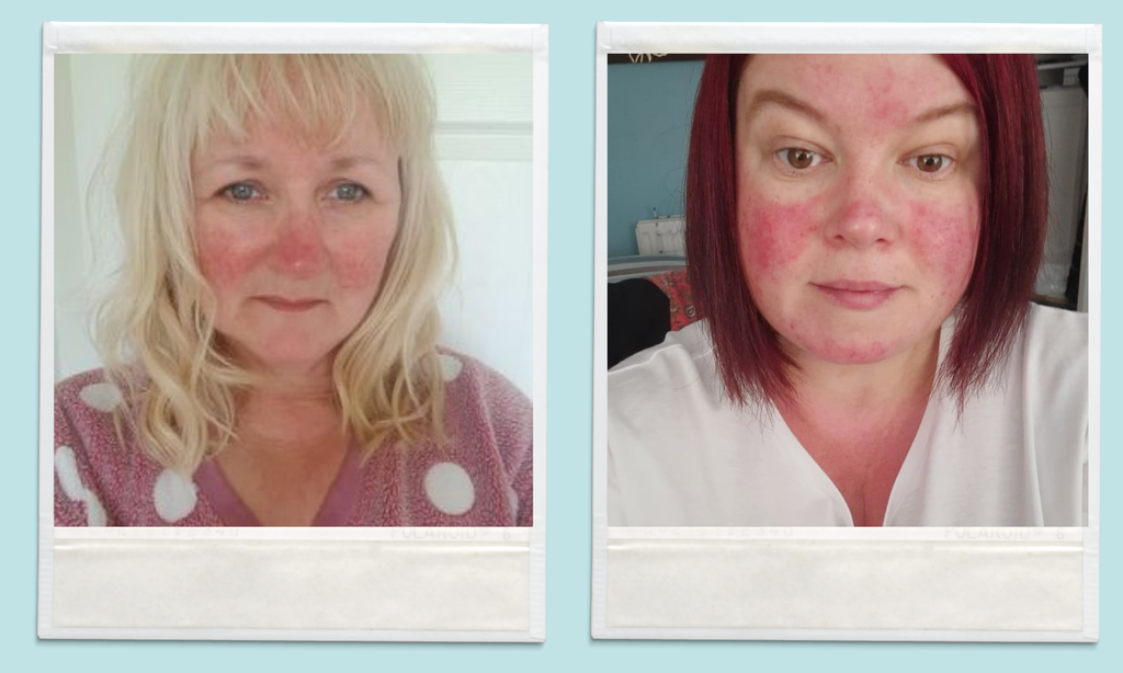 Everything You Need to Know About Rosacea