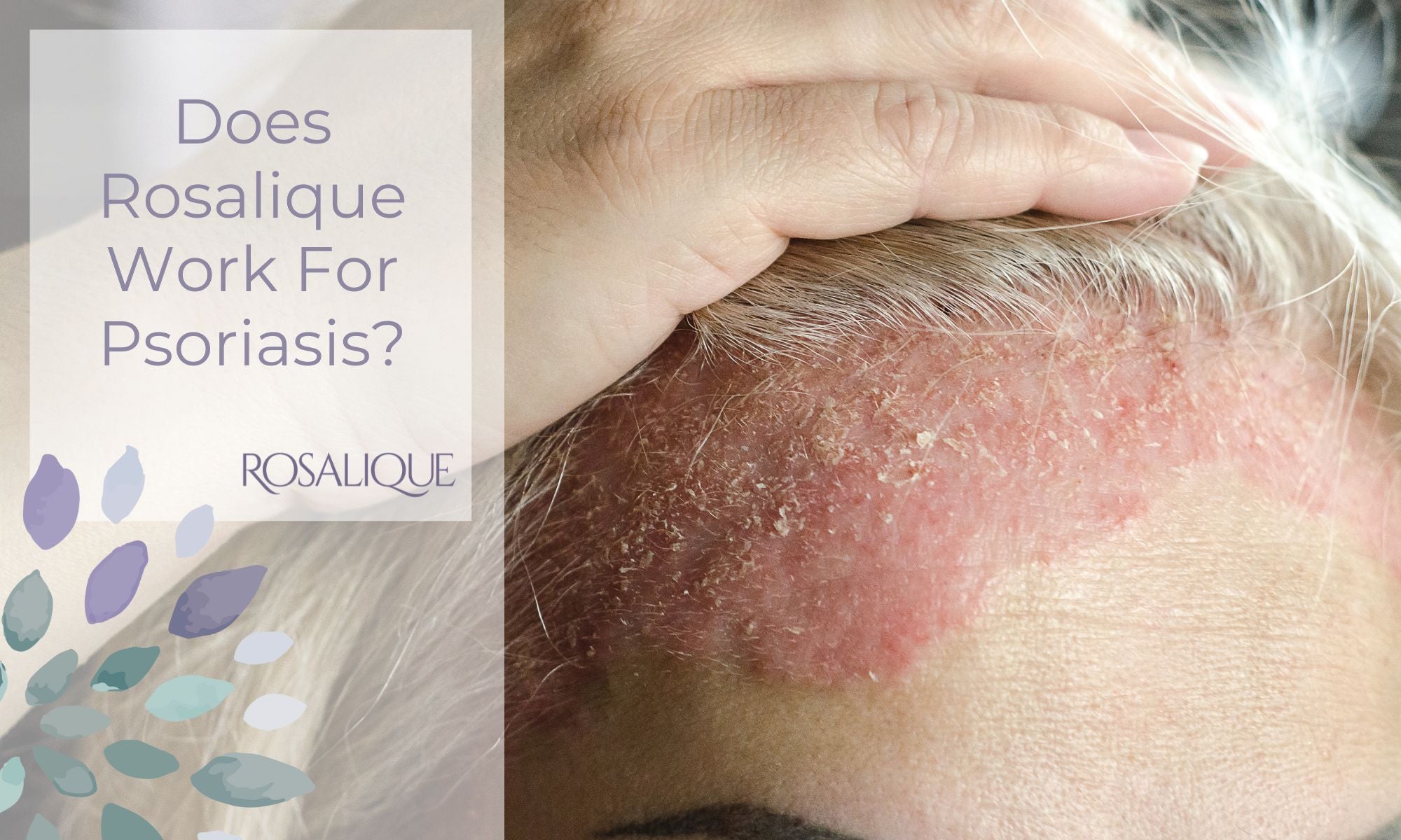 Does Rosalique 3 in 1 Miracle Formula work for psoriasis?