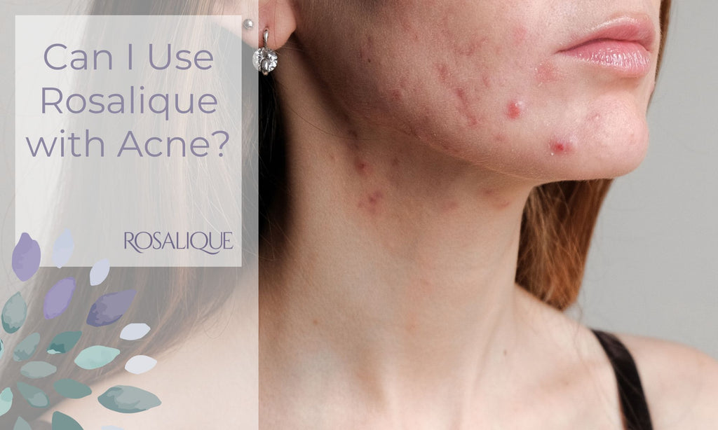 Does Rosalique work for Acne?