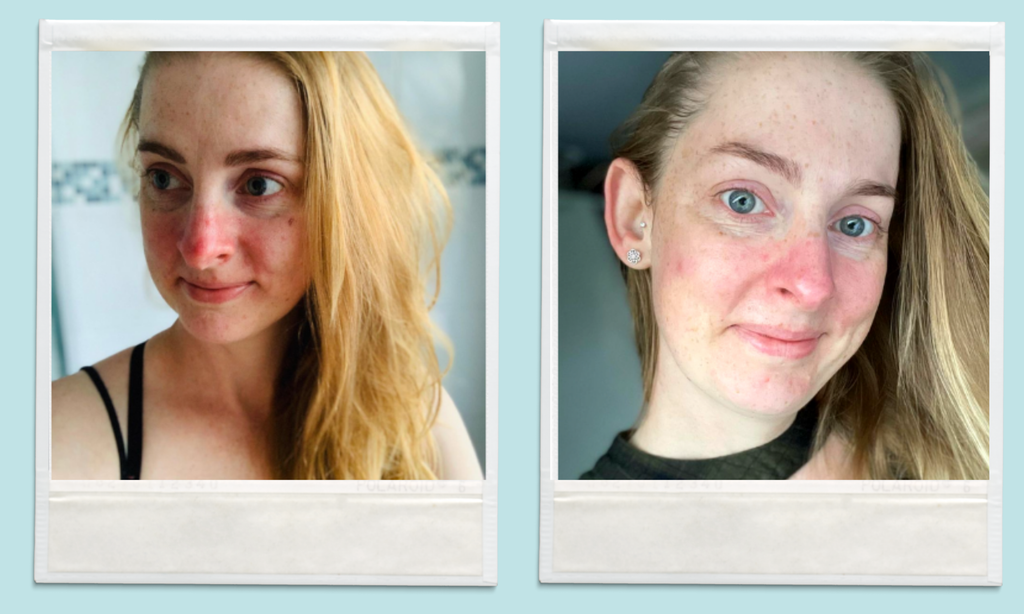 Rosacea, Healing & Self-Love – Becca's Story