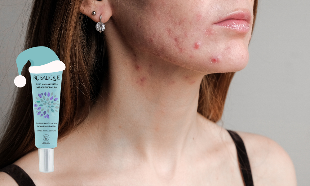 Looking After Your Congested Skin During The Holidays