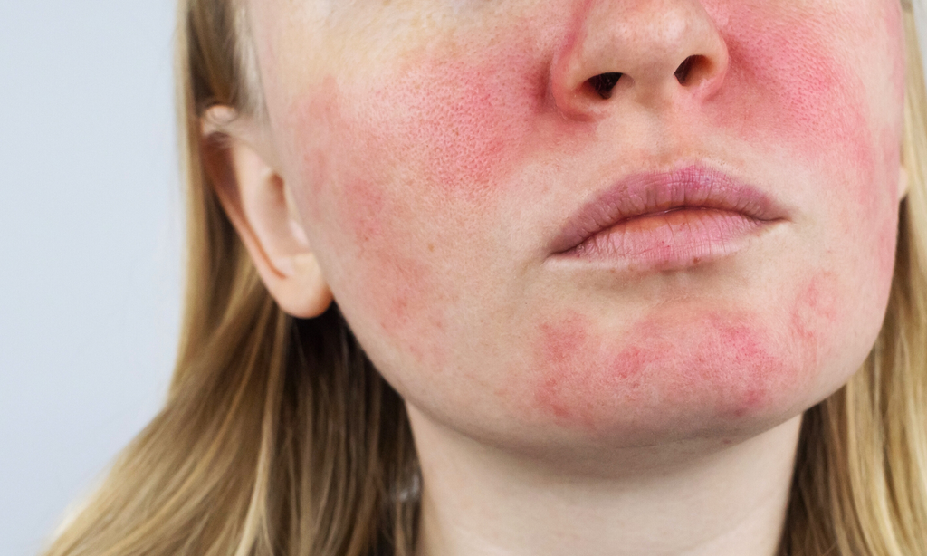 Rosacea 101