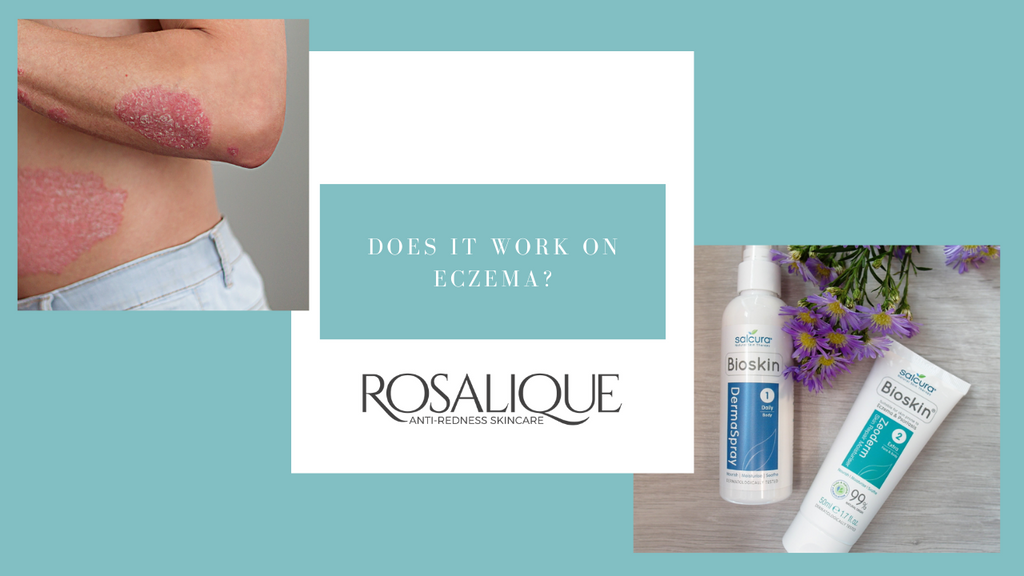 Does Rosalique work when I have eczema?