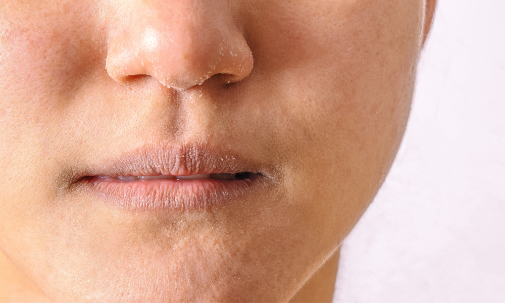 What makes Rosalique suitable for eczema - our 5 active ingredients explained